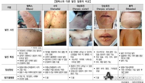 엠폭스‘주의’단계 격상.. 오산시, 감염병 감시체계 강화